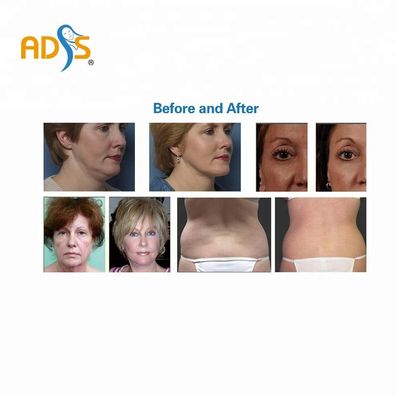 OEM Salon Thermage RF Makinesi Cilt Sıkılaştırma Zayıflama Güzellik Ekipmanları